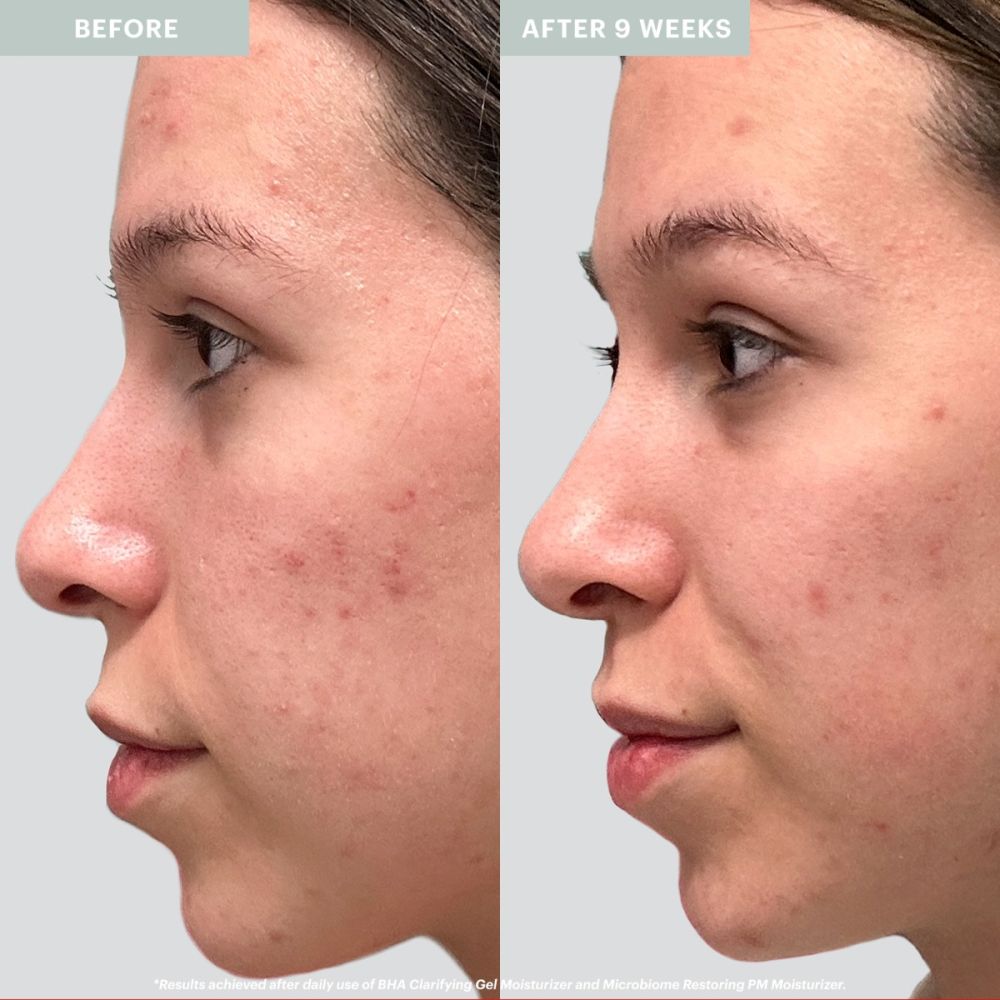 BHA Clarifying Gel Moisturizer - Glo Skin Beauty UK&I